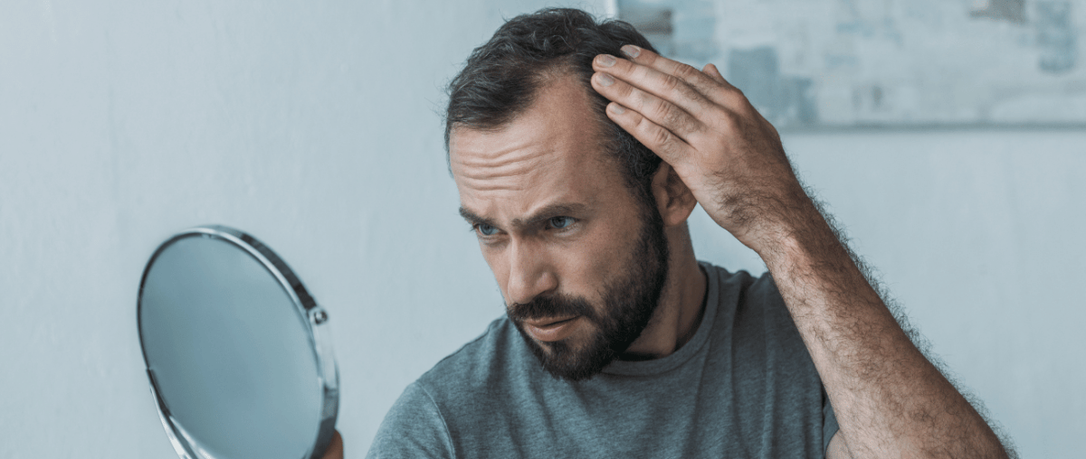 Haarausfall bei Männern - IMPERIO COSMETICS
