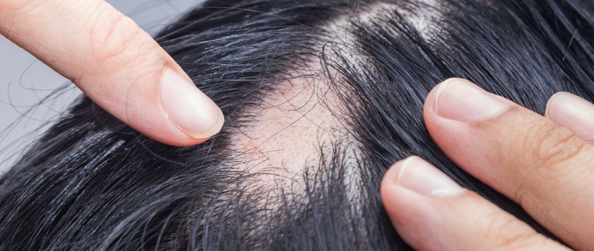 Kreisrunder Haarausfall - IMPERIO COSMETICS